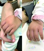 浅谈蓝婴综合症